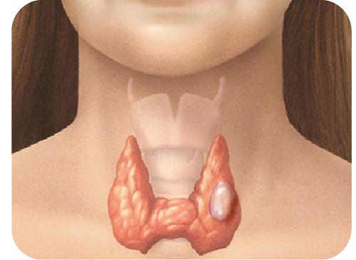 Khám và tư vấn miễn phí cho người bị bướu giáp nhân