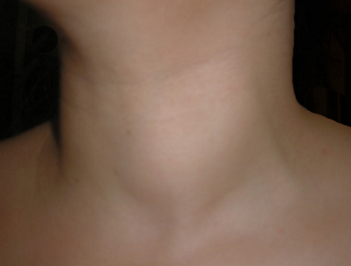 Khám và tư vấn miễn phí cho người bị bướu giáp nhân