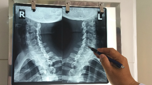 Thoái hóa đốt sống cổ âm thầm tấn công giới văn phòng