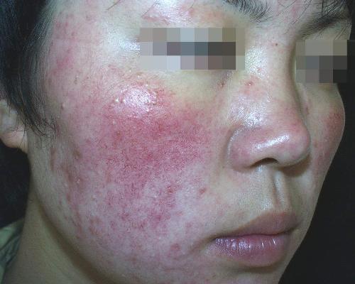 Tẩy trắng da cấp tốc - mối nguy hại khôn lường