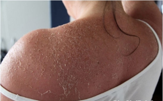 Tẩy trắng da cấp tốc - mối nguy hại khôn lường