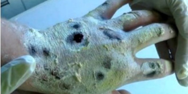 Cảnh báo về tác hại loại 'ma túy cá sấu' nguy hiểm nhất thế giới