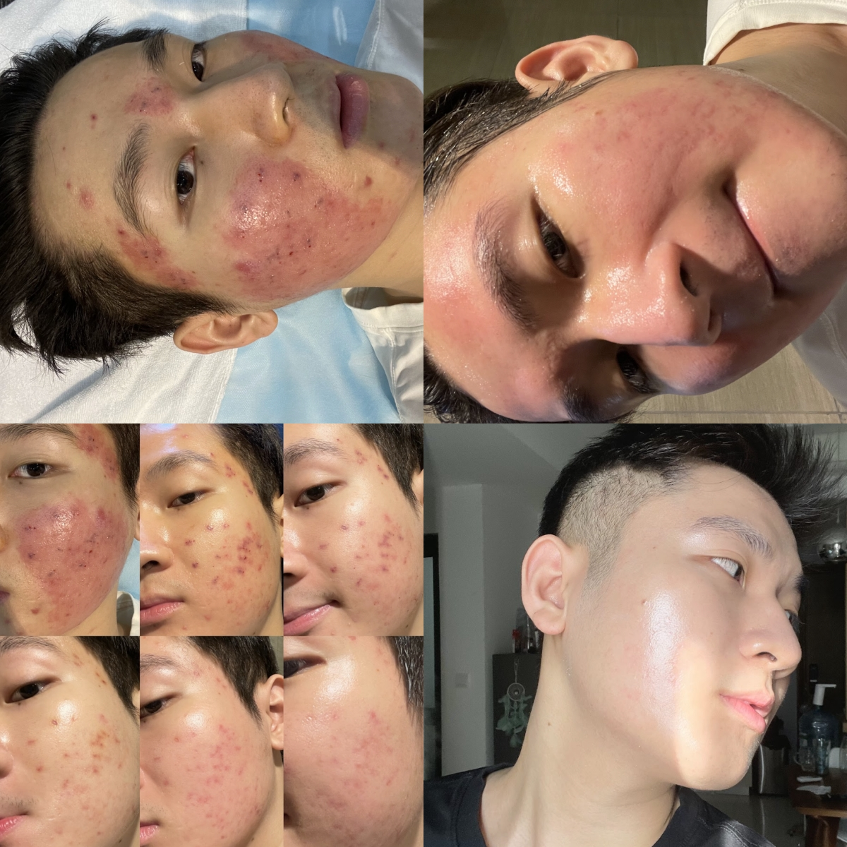 TikToker Bimm từng muốn bỏ nghề vì da xấu